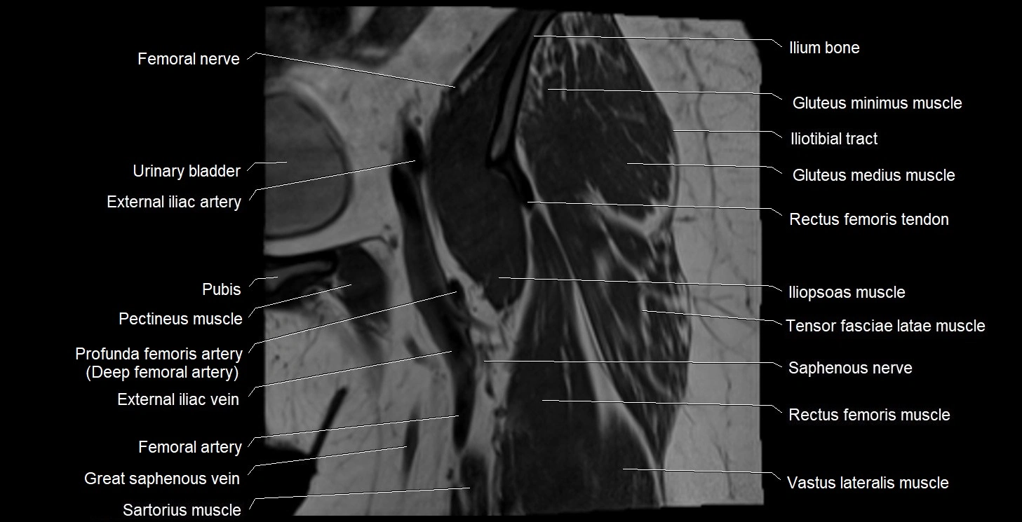 MRI Hip 3T coronal cross sectional anatomy image 13.webp
